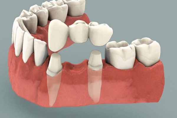 В каких случаях показана установка несъемных зубных протезов?