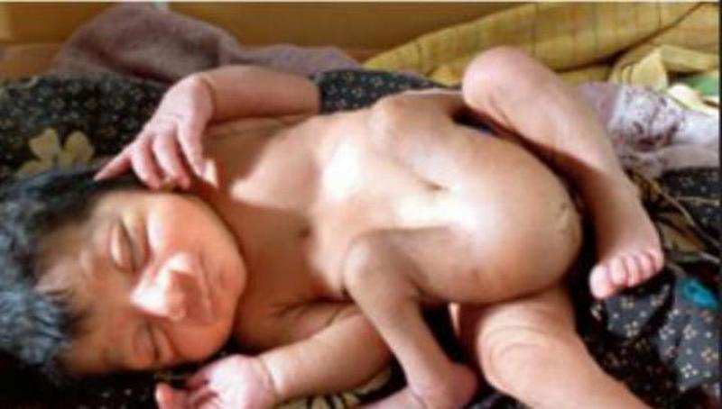 В Индии родился ребенок с шестью конечностями