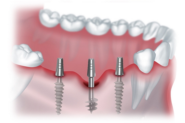 Особенности и этапы имплантации зубов