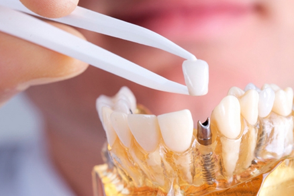 Имплантация зубов в клинике «Доктор Смайл»: особенности
