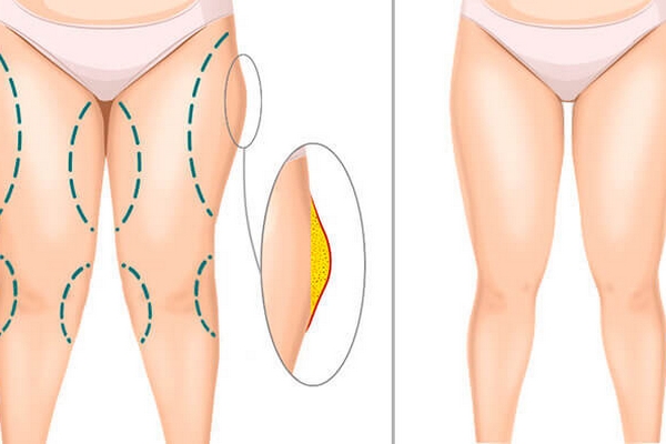 Липосакция ног: преимущества косметической операции