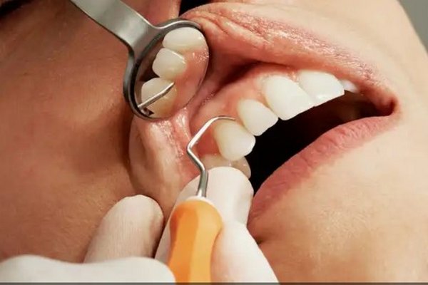 Кариес и инсульт: как заболевание зубов может привести к смерти