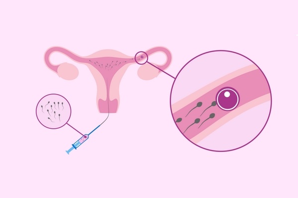 Внутриматочная инсеминация: что это процедура и в чем ее особенности