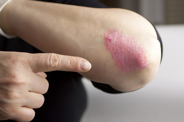 Составлен список самых опасных заболеваний кожи